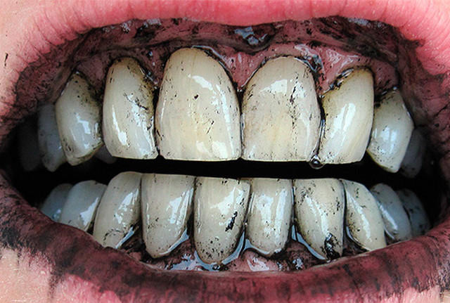 Після чистки активованим вугіллям зуби дійсно стають чистішими і біліше