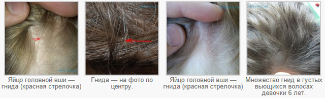 На перших трьох знімках ми бачимо головний воша в природному середовищі існування - на волосистій частині голови, а також загиблих від обробки дорослих особин (та, що темніше, напилася крові, та, що світліше - не встигла)