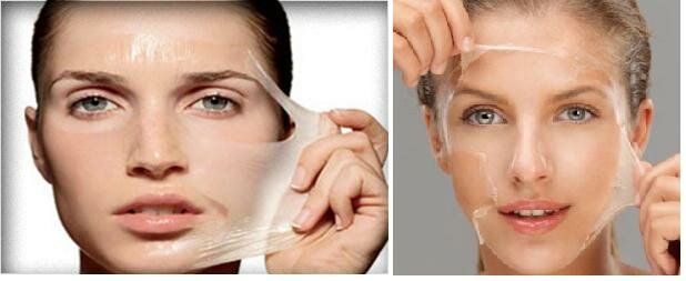 Процедура хімічного пілінгу проста, в результаті неї шкіра вирівнюється і зменшується сітка зморшок під очима