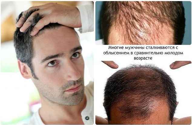Причини випадіння волосся у чоловіків